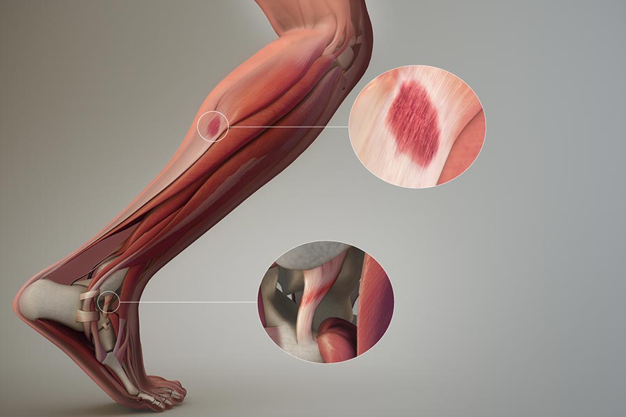 Lesioni muscolari - Terapia ultrasuoni